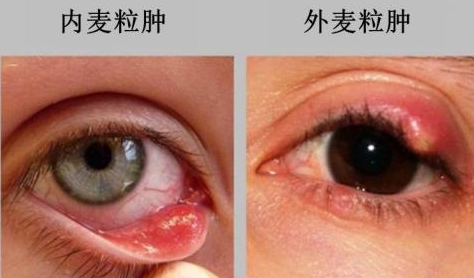 小孩子眼睛长麦粒肿怎么办,长了麦粒肿解决办法