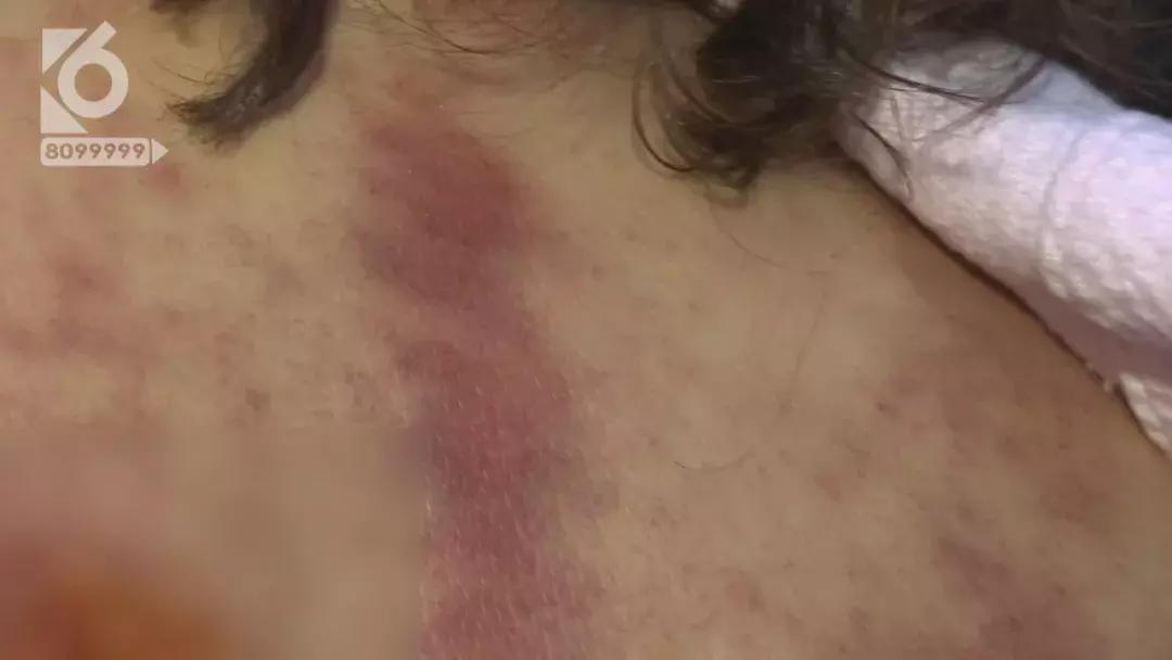 女性湿气太重拔火罐有用吗,拔火罐后有水泡是烫伤还是湿气