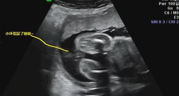 澶╂墠鑳庡効瀹岀粨,澶╂墠鑳庡効