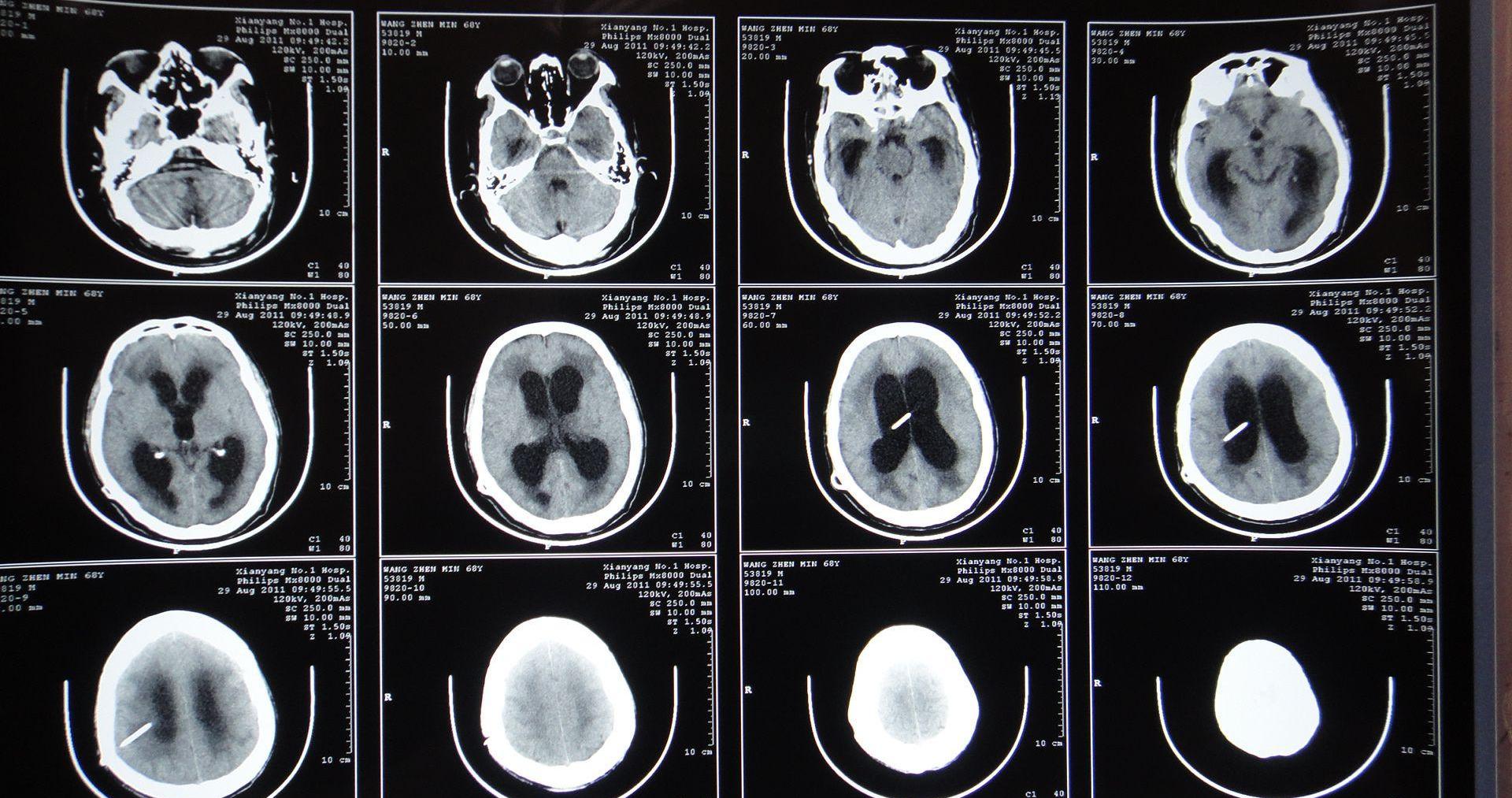 脊膜膨出与脊膜脊髓膨出,先天性脊髓脊膜膨出怎么治疗