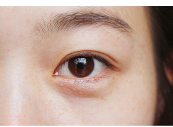 眼皮一直跳预示什么疾病,眼皮总是跳是什么病的征兆