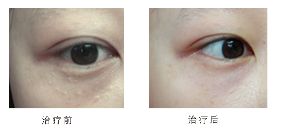 眼周围长出很多小疙瘩是怎么回事,眼睛长了个疙瘩能擦红霉素眼膏吗