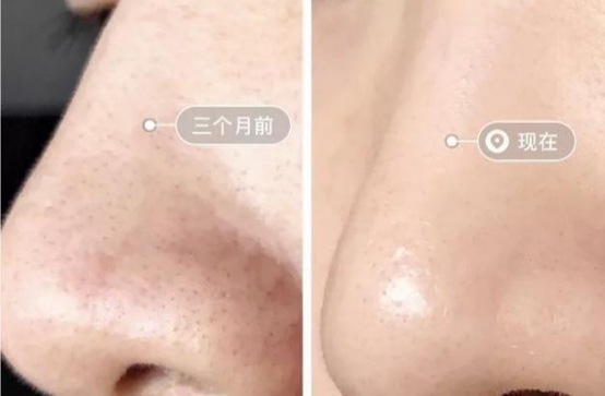 婴儿黑头怎么处理脸颊,如何去黑头5个诀窍告别草莓鼻