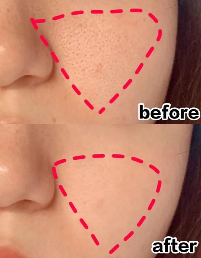 闭口粉刺去美容院清闭口好吗,如何正确去除粉刺闭口