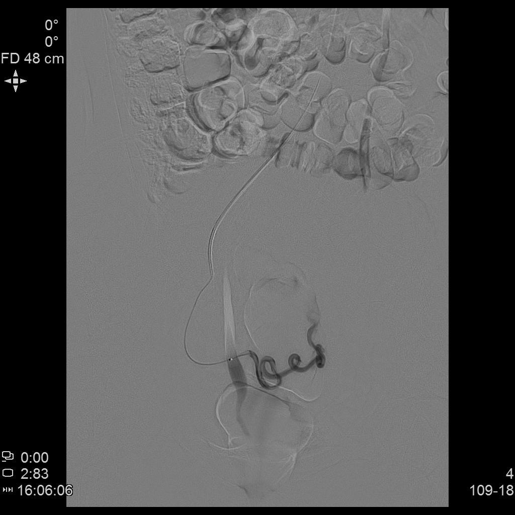 从手腕处做子宫动脉栓塞手术,子宫肌瘤做动脉穿刺有危险吗