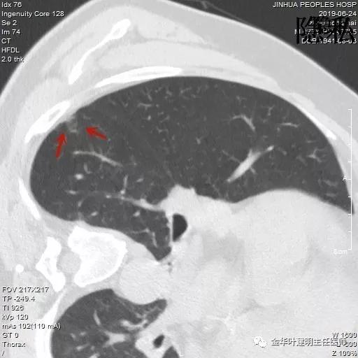 警惕-会是简单的肺大泡吗？