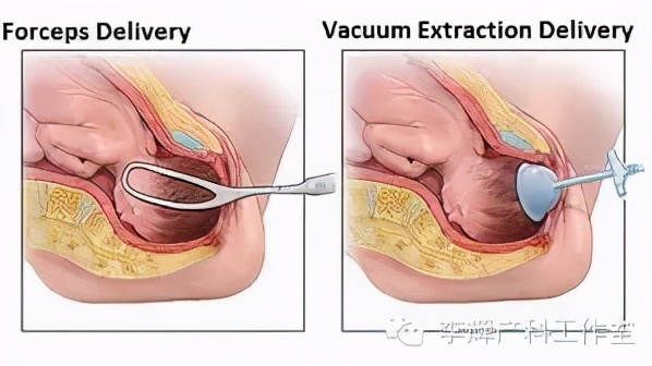 阴式分娩（自然分娩）知情同意书的专业解读