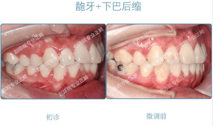杭州成人隐形矫正牙齿优惠,矫正牙齿杭州无创伤