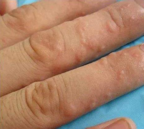 手上长汗疱疹去挠脚是不是会传染,汗疱疹手痒越挠越痒怎么缓解