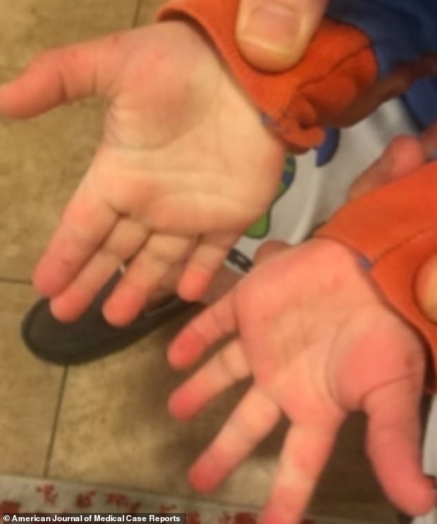 抗病毒治疗阿昔洛韦,抗病毒药膏阿昔洛韦