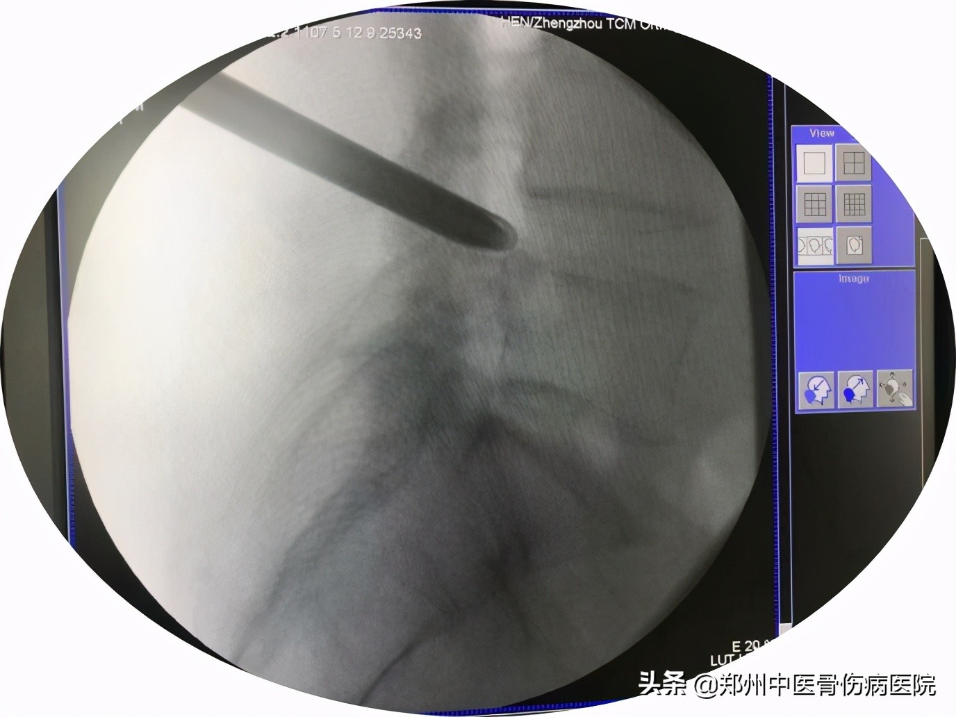 腰腿痛治半年多没效果,腰腿痛有做小针刀好的吗