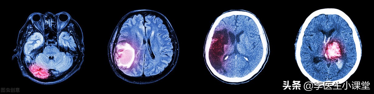 家人脑出血住院家庭怎么办,家里人出现脑出血家庭急救方法
