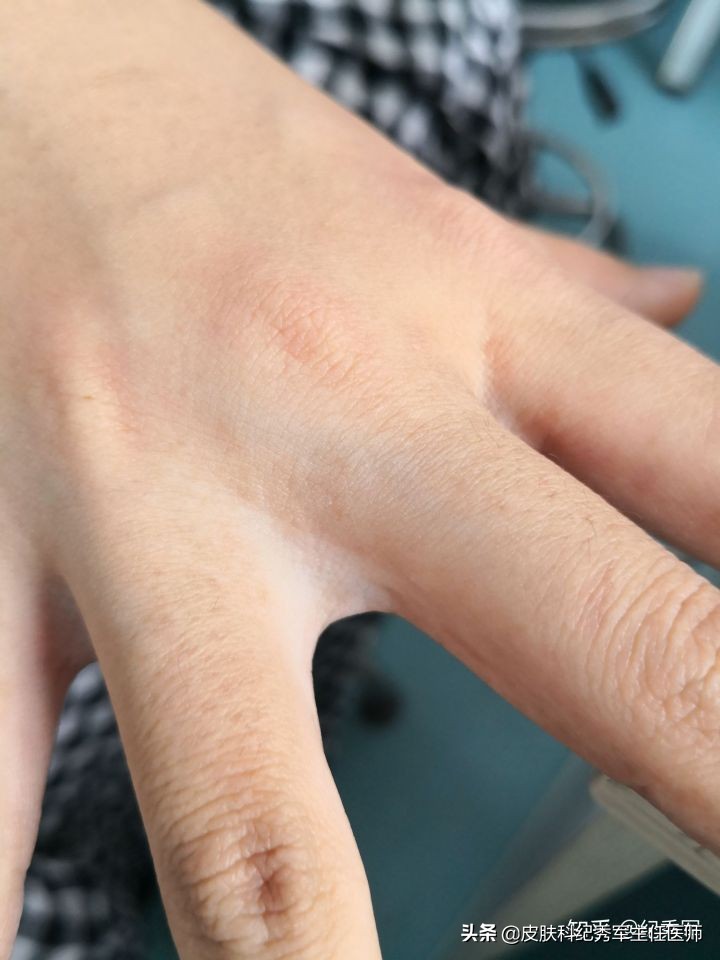 疥疮具有诊断意义,疥疮在临床上如何确诊