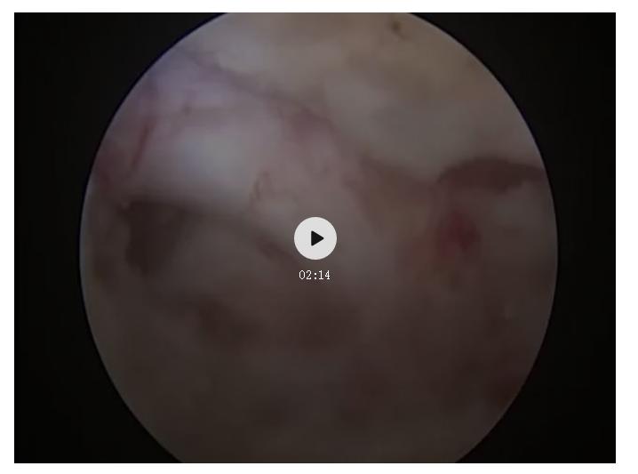 脊椎狭窄压迫神经腿疼怎么治疗,神经根痛上肢麻木怎么康复