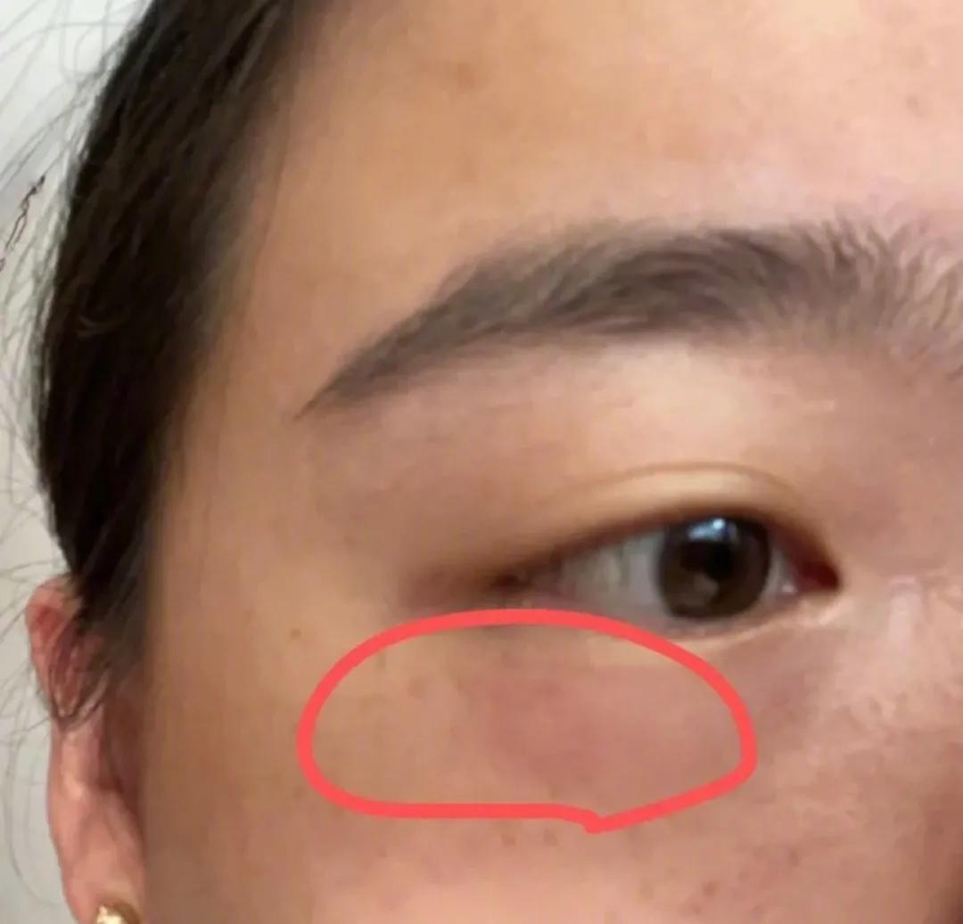 晚上玩手机会毁容的虫子,前一晚关灯玩手机被虫毁容