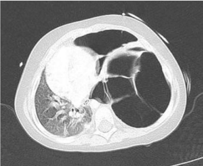 ige高引起湿疹,湿疹与特异湿疹有什么区别