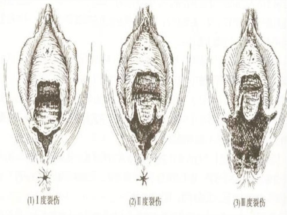 孕妈出血,孕12周胎盘前置有出血该怎么办