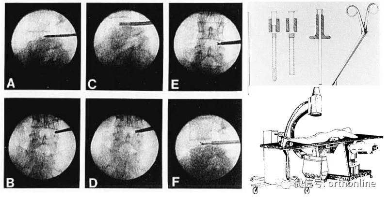 从“脊髓镜”谈到UBE/BESS:追溯脊柱内镜演化史(上)