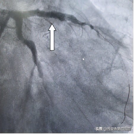 我院完成首例冠脉介入治疗,你是我的眼睛医院