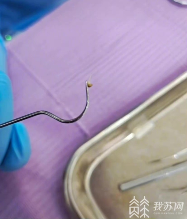 草莓籽在牙齿缝里发芽了怎么办,草莓只卡牙缝里发芽了