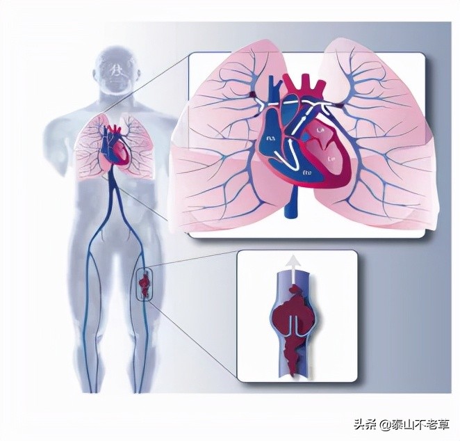 腿弯处突然肿了一块怎么回事,老年人腿肿突然消失是怎么回事