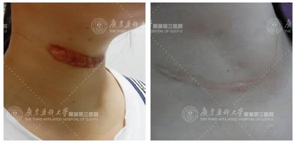 甲状腺手术后疤痕增生期是多久,甲状腺结节手术后疤痕怎样消除