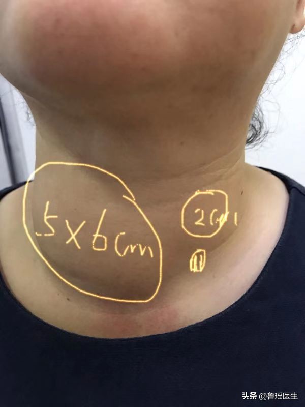 拖延回避、吃中药转了一圈后这位甲状腺结节患者还是选择了手术