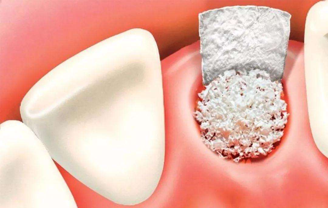 种植牙对骨头的危害可以恢复吗,老年人种植牙有哪些危害呢