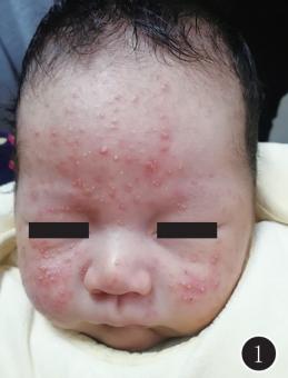 宝宝反反复复长痘痘怎么办,小宝宝常见病护理