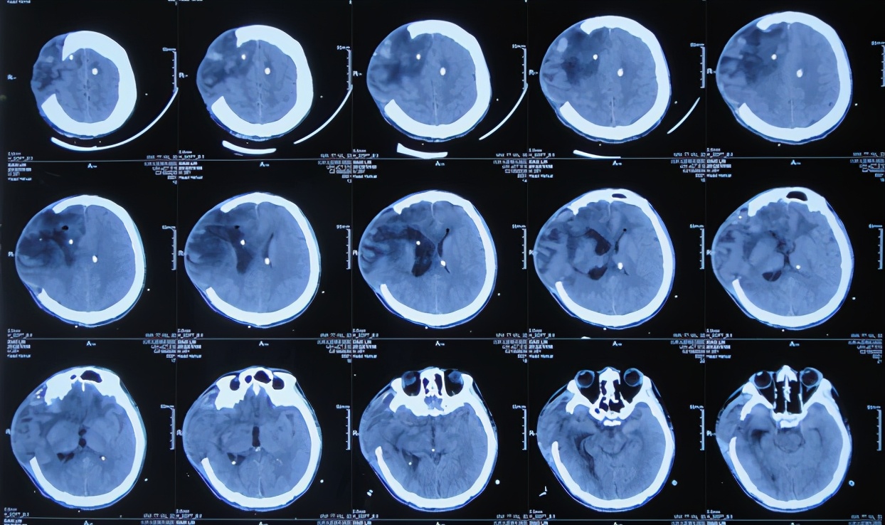 开颅手术后颅内细菌感染图片,外伤开颅手术后脑积液能恢复吗