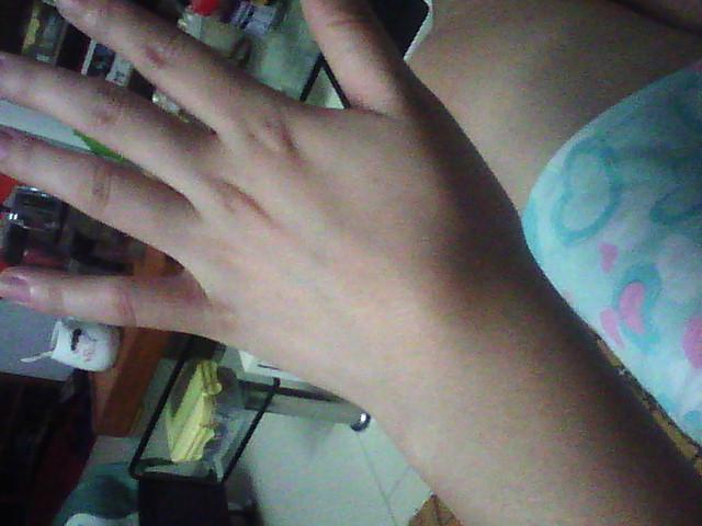 腕部腱鞘囊肿怎么治疗,奶奶抱孩子累得腱鞘炎怎么办