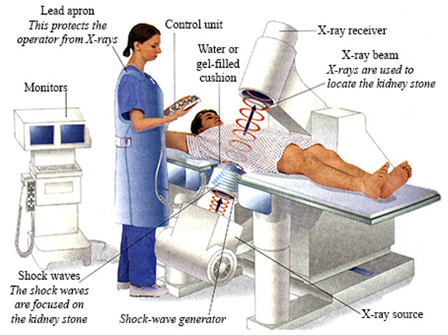 体外冲击波碎石术后肌酐升高，中药合理治疗后，肌酐戏剧性下降了