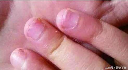 指甲变脆有竖纹怎么办,指甲变脆容易折断是什么原因