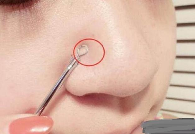 鼻子毛孔粗大挤出白色物质怎么办,鼻子上挤出白色东西去除小妙招
