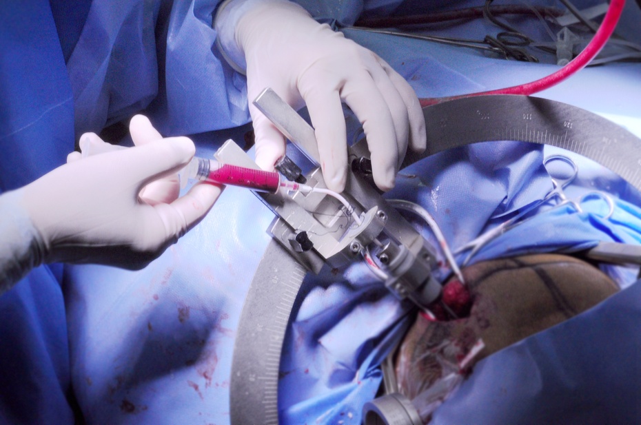 立体定向脑干血肿清除术,脑干血肿清除术