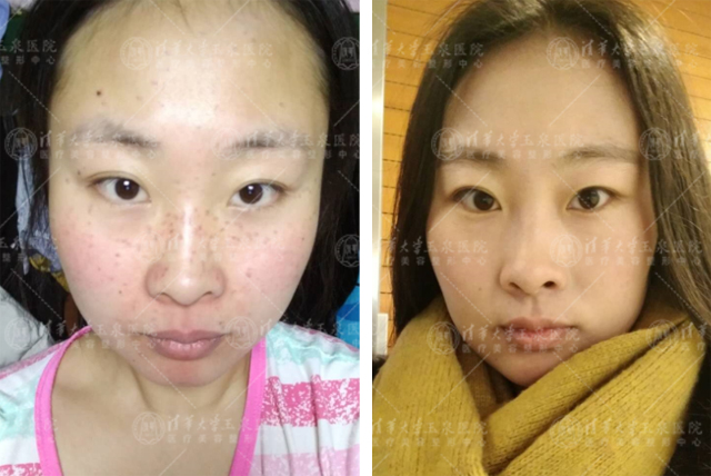 液氮祛斑和激光祛斑哪个效果好,超皮秒激光祛斑的危害与效果视频