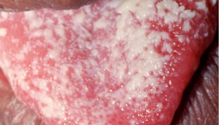 小孩嘴唇鹅口疮什么样,小孩长鹅口疮是缺维生素多少