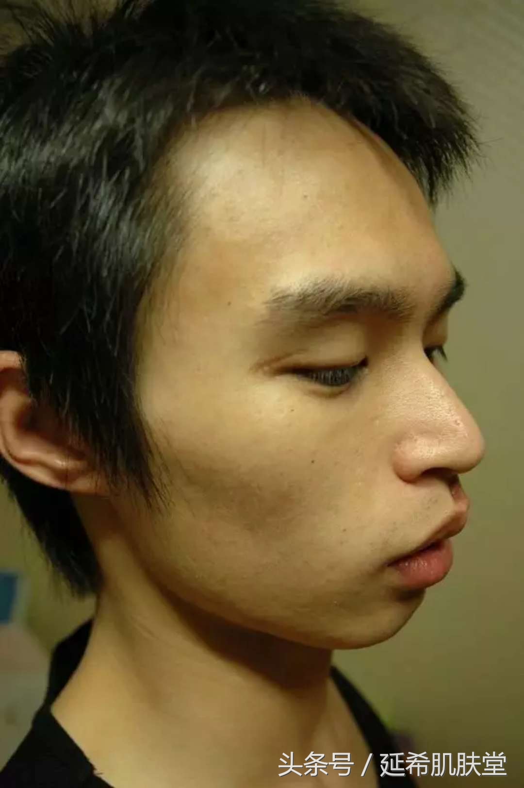 不想自己长痘怎么办,五天淡痘印的办法