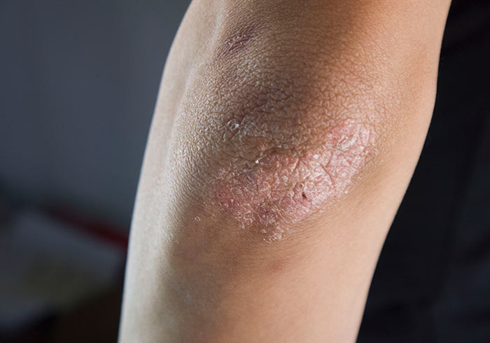 春天湿疹中医治疗法,春季湿疹中药调理