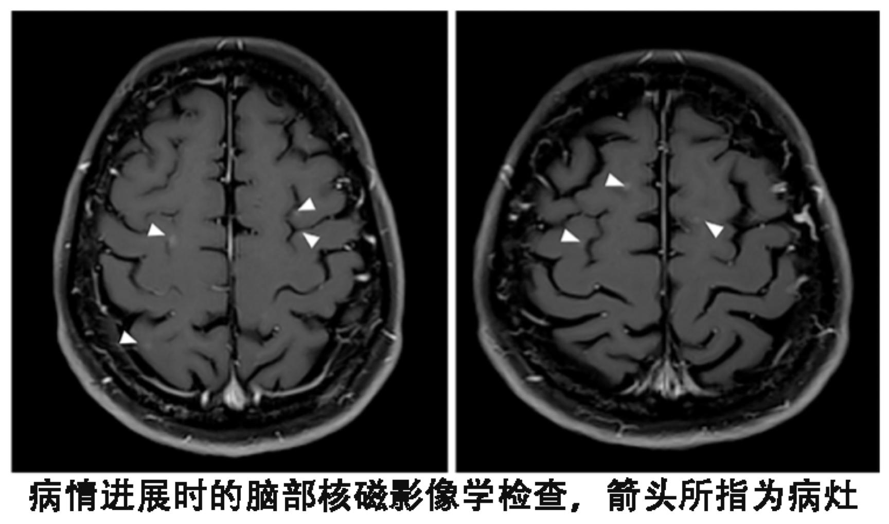 奇迹癌症居然消失了,奇迹肺癌
