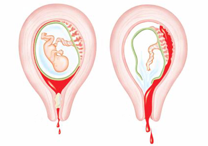孕早期阴道出血,该怎样治疗和预防?