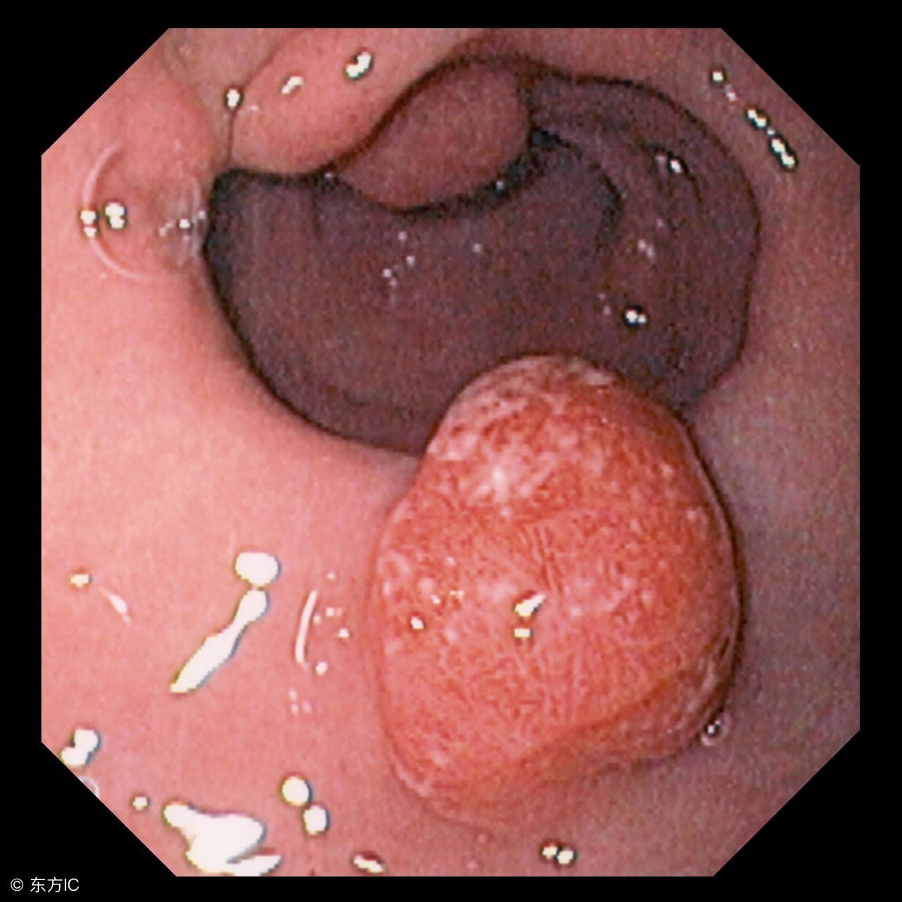 无痛胃肠镜麻醉后多长时间醒,无痛胃肠镜后多长时间进食