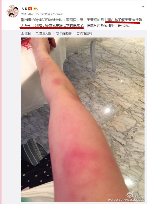 大s癫痫住院真相,大s回应因癫痫住院一事