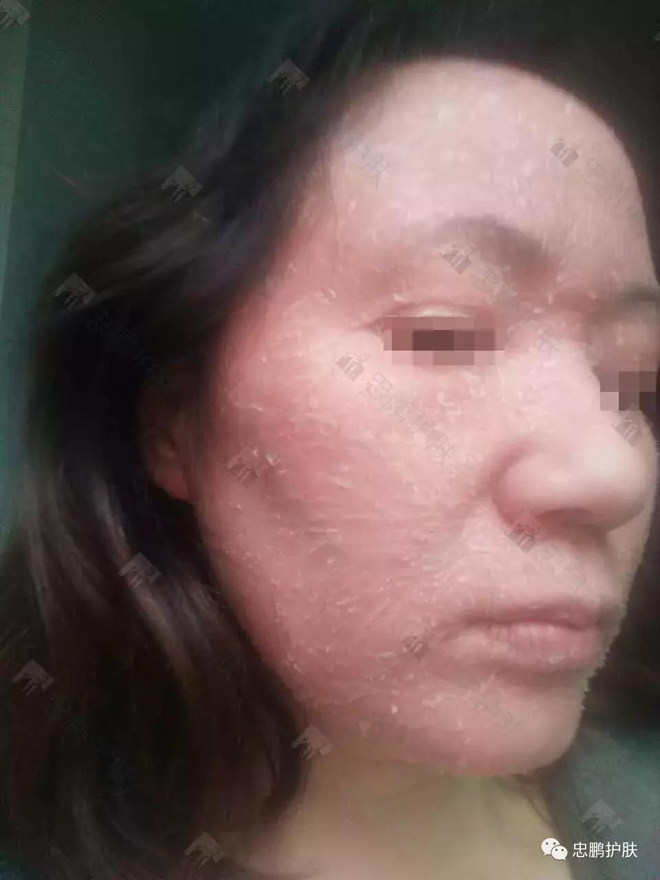 激素脸发红发热脱皮怎么办呢,激素脸为什么会扩散到脖子上代谢