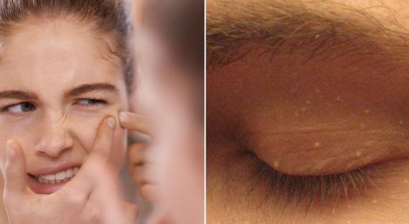 脸上莫名的小颗粒到底是什么？皮肤专家教你护肤