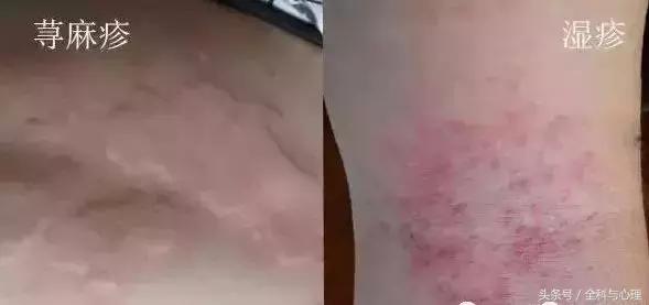 湿疹和麻疹区别,麻疹和湿疹的区别