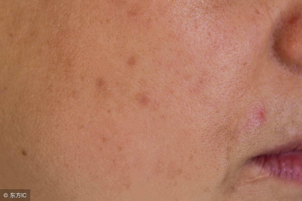 暗疮是体内有什么问题吗,暗疮原因