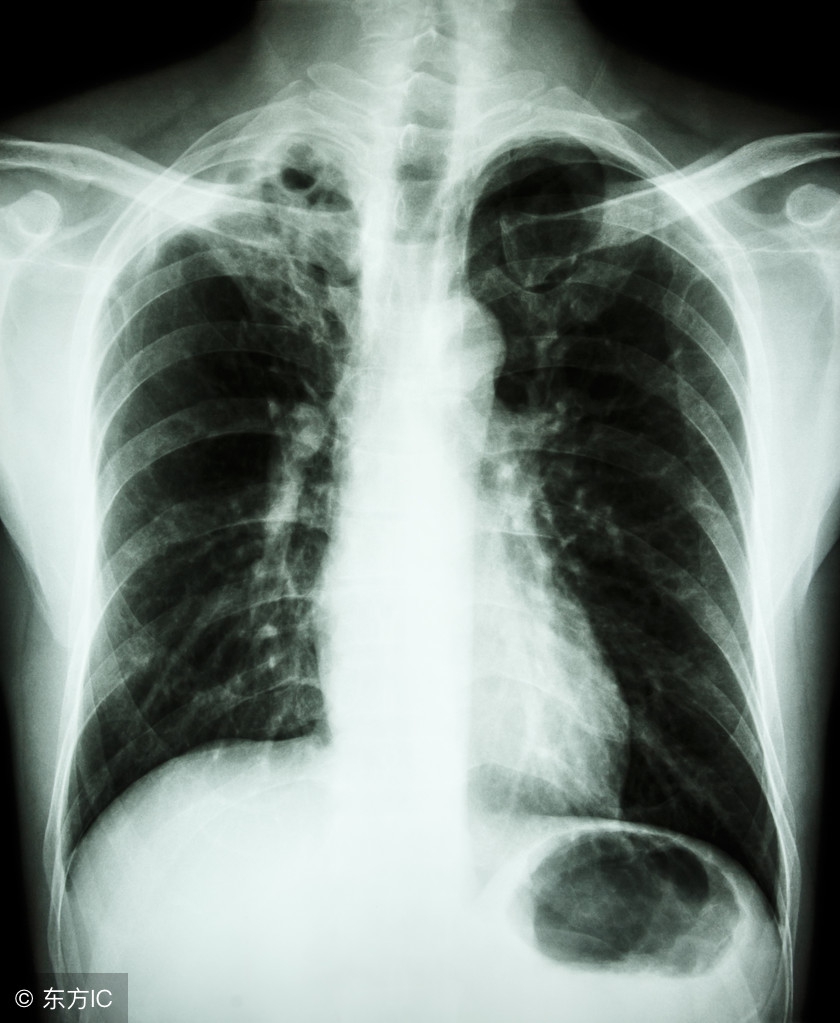 肺结核杆菌是什么杆菌,肺结核空洞里面有曲霉菌