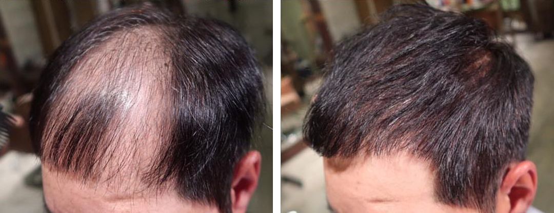 圆脸发际线高的男生适合什么发型,发际线高头发稀少发型男