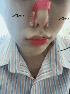 整形“神器”大测评：传说中的隆鼻夹真的靠谱吗？